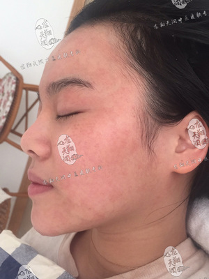 调理激素皮炎，中医康复实录 | 龙翔天润患者案例分享